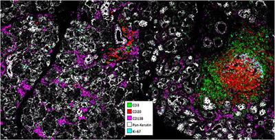 Heterogeneity of antibody-secreting cells infiltrating autoimmune tissues